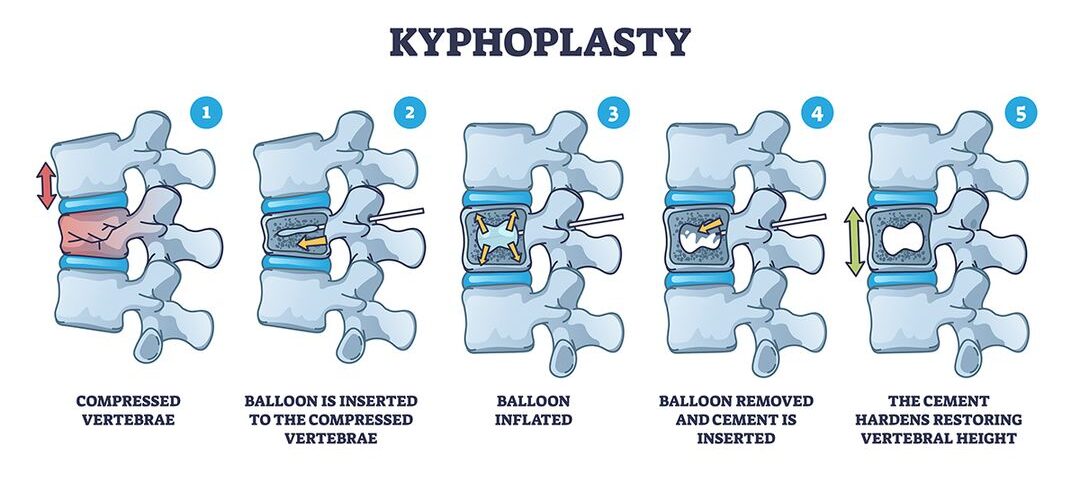 Vertebral compression fracture (VCF): Vertebroplasty and Kyphoplasty